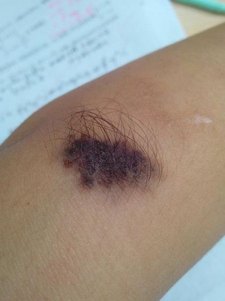 長毛的痣(到底會(huì)影響健康嗎)